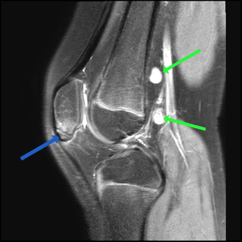 Sinding-Larsen-Johansson Syndrome - ProScan Education